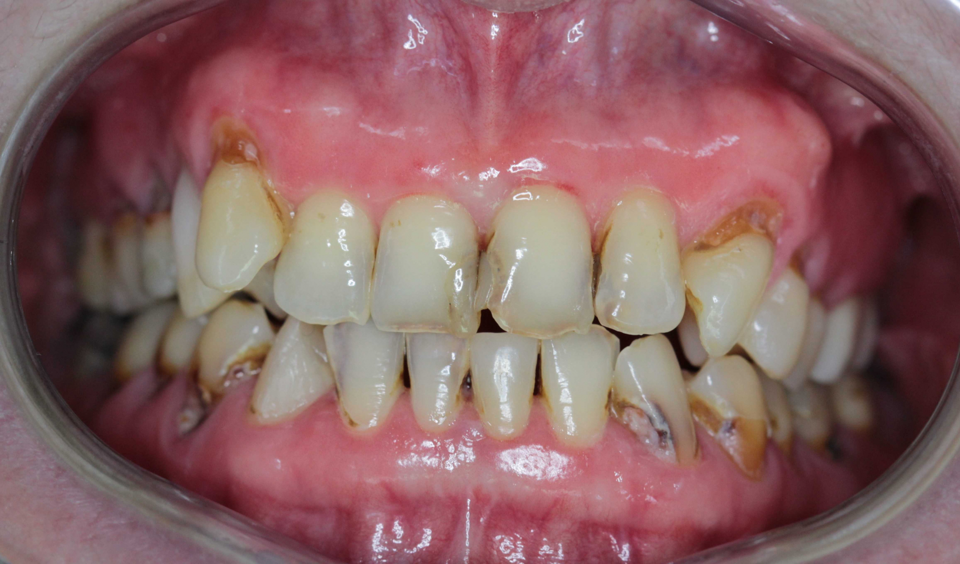 Before the procedure