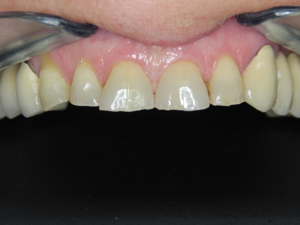 RECONSTRUCTION OF THE ENTIRE UPPER JAW – ZIRCONCERAMIC BRIDGE, E.MAX CROWNS AND PROSTHETIC TREATMENT