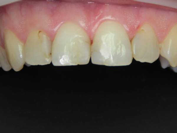 ALL-CERAMIC E.MAX CROWNS OF UPPER INCISORS