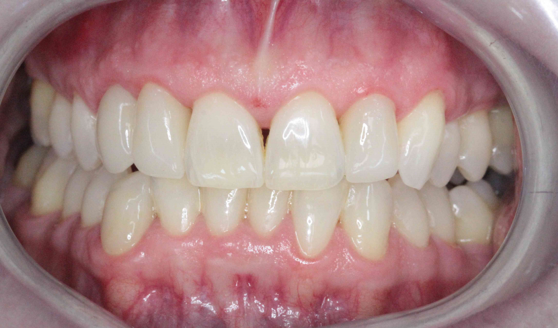 After the procedure
