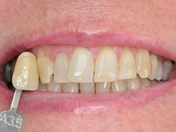 Purewhitening combined whitening