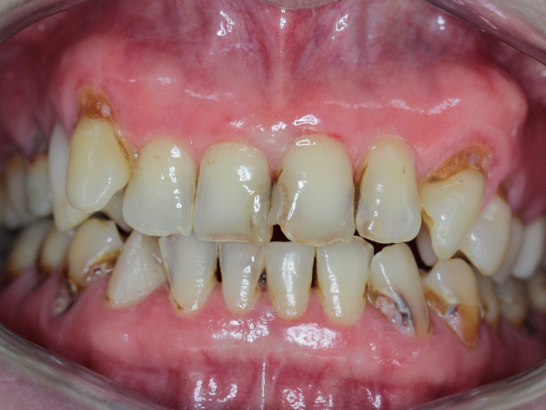 When Prevention Isn’t Enough: A Precision-Driven Full Mouth Reconstruction